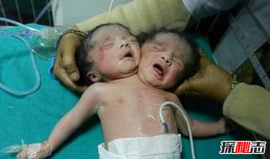 巴西双头婴儿意外诞生，两个头颅共用一个身体(依旧存活)