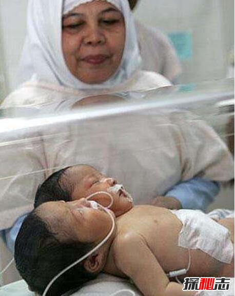 巴西双头婴儿意外诞生，两个头颅共用一个身体(依旧存活)
