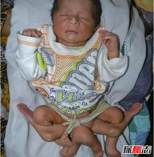 巴基斯坦6条腿的男婴，堂兄妹通婚生6条腿男孩/寄生胎儿