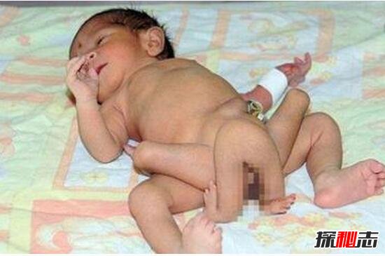 巴基斯坦6条腿的男婴，堂兄妹通婚生6条腿男孩/寄生胎儿