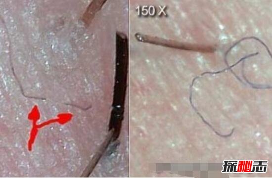 转基因莫吉隆斯症，五彩纤维从身体长出/虫子在皮肤下蠕动