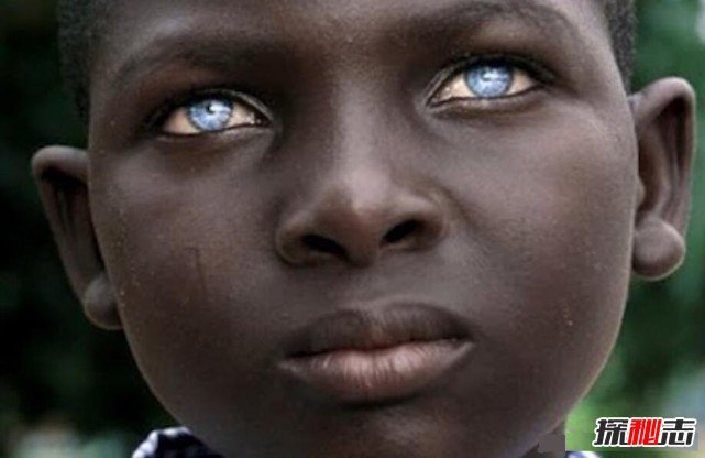 十大世界上最稀有的瞳孔色：你见过银色、粉色瞳孔吗？