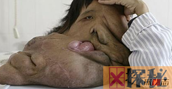 世界上长得最恐怖的人:湖南象人黄春才(脸上15公斤神经纤维瘤)