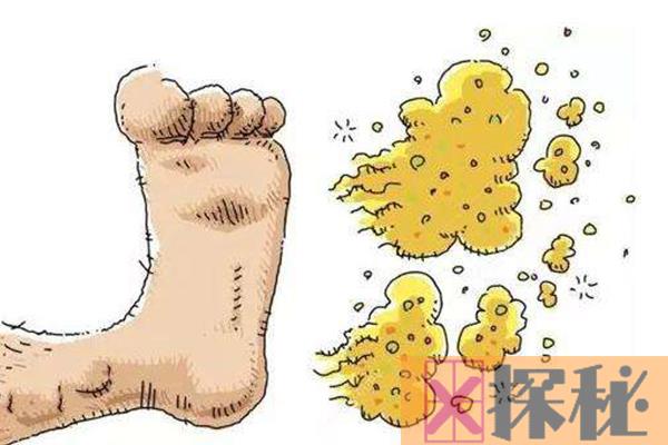 香港脚是什么意思?足癣为什么叫做香港脚