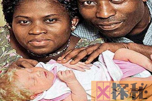 为什么黑人父母会生出纯白宝宝?不明基因突变(金发蓝眼)
