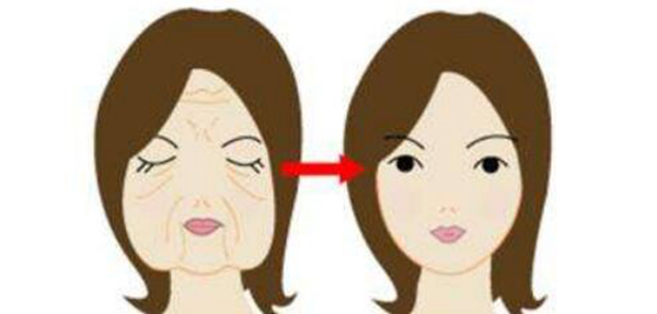 拉皮的危害有哪些 可能导致神经受损表情不自然