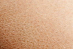 皮肤起皮屑怎么办 预防皮肤起皮屑的方法有哪些