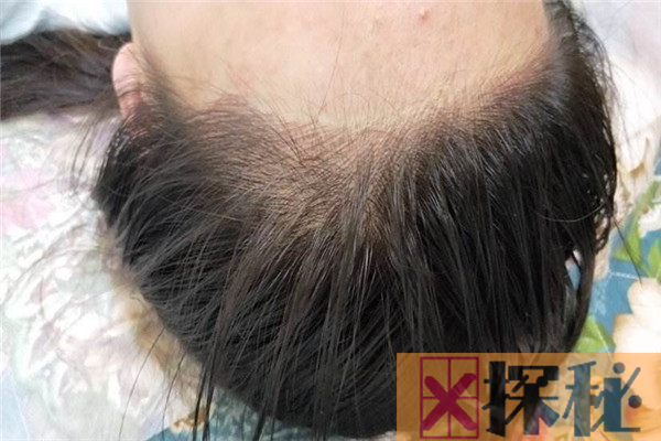 纹发际线的危害有哪些 纹发际线会留下隐性的疤痕