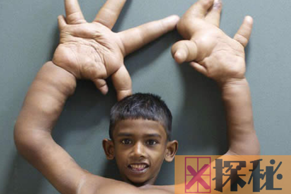 世界罕见巨指症男孩:双手重达12.7公斤(被称诅咒之人)