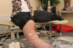 世界上最大最粗的腿是谁 曼迪·塞拉斯（双腿重两百多斤）