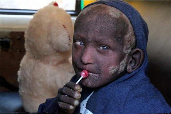 世界上皮肤最硬的人是谁 印度的小男孩尼尔（患病导致）