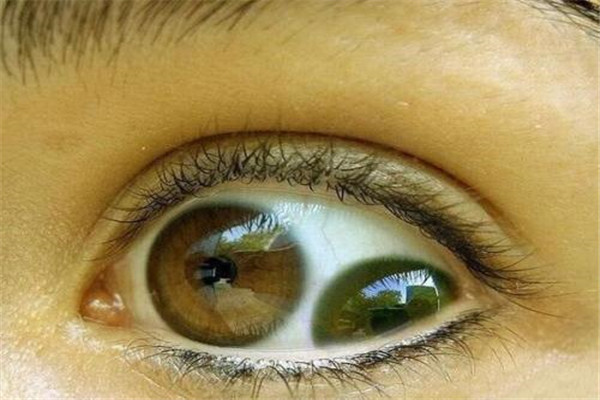 人类5种罕见的瞳孔 其中不少瞳孔看起来非常恐怖