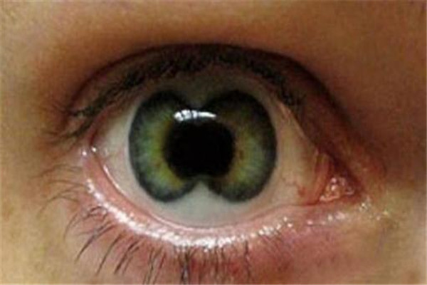 人类5种罕见的瞳孔 其中不少瞳孔看起来非常恐怖