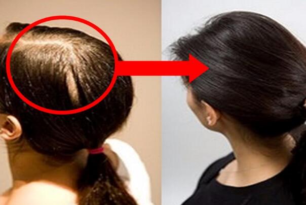 脱发是什么原因引起的?与遗传因素有关，预兆身体有疾病