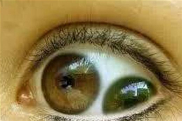 双瞳孔看到的世界是什么样的：和普通人一样（位置变化）