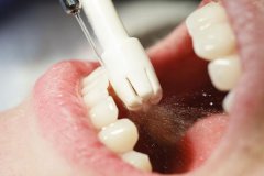 洗牙的好处和坏处:易导致牙缝大(但能预防牙周疾病)