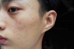 脸上长痘痘的位置和原因：鼻头长痘(胃火大且消化异常)