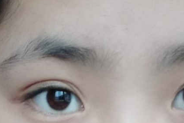 眉毛稀少是什么原因：先天性遗传导致(内分泌失调导致)