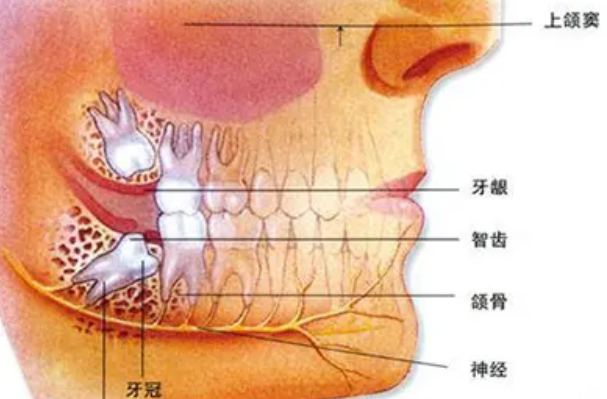 智齿怎么长是正确位置：完全垂直(不会挤压到邻牙)