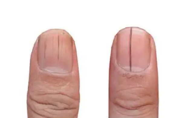 指甲有竖纹是身体的什么信号：缺少营养等(也是正常现象)