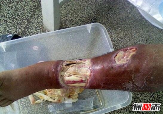 原矛头蝮龟壳花蛇，0.12毫克毒液让人溃烂致死(咬伤图片)