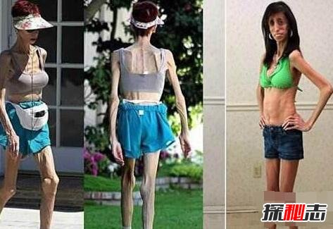 世界最丑骷髅女孩丽兹·维拉斯奎兹，每天吃60顿饭却零脂肪