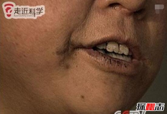 中国辽宁吃煤的女人，34年吃掉5000公斤的煤(异食症)