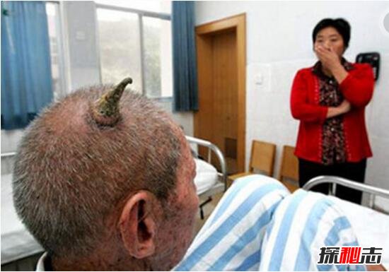 百岁老人头上长“犄角”之谜，预示癌症病变(皮肤肿瘤)