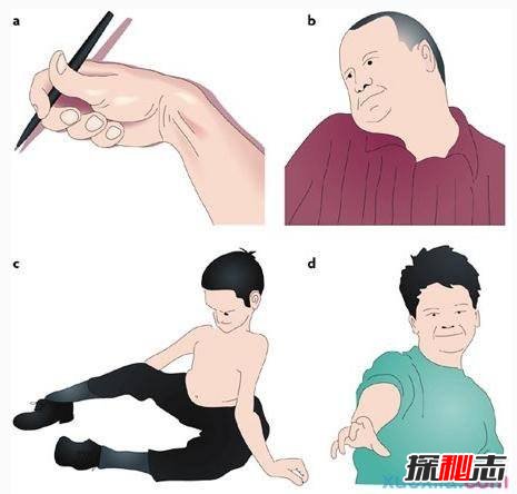 中国世界首例舞蹈猪,亨廷顿氏舞蹈症是什么病？