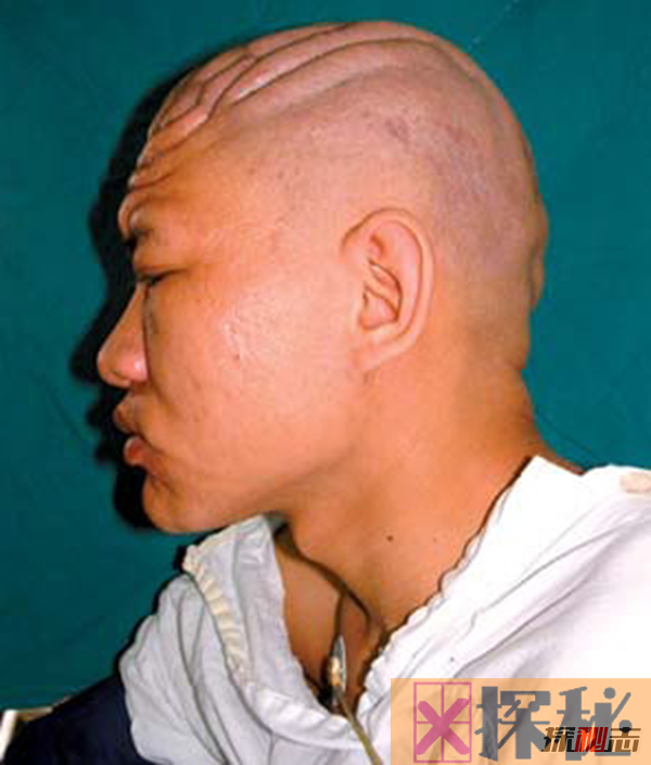 广州女孩患骨膜增生厚皮症,面部褶皱如古稀老人(染色体显性遗传)