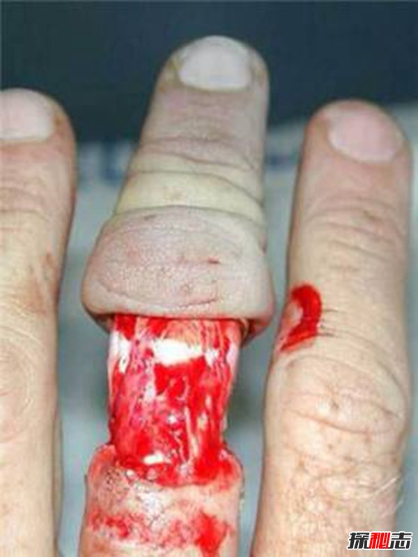 打保龄球戴戒指,手指上的肉会被活生生的剥落