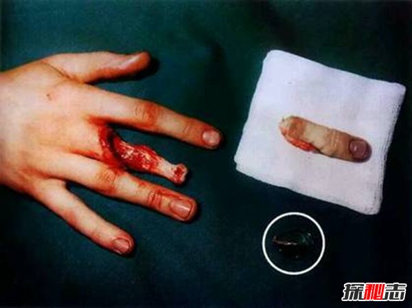 打保龄球戴戒指,手指上的肉会被活生生的剥落