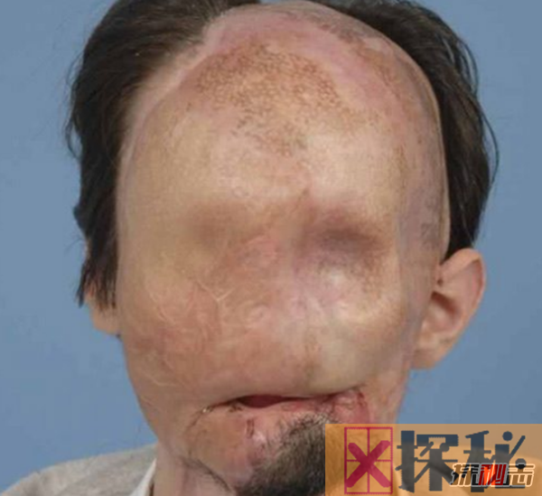 世界上十大最古怪的男人,20岁小伙没有脸可以活两年