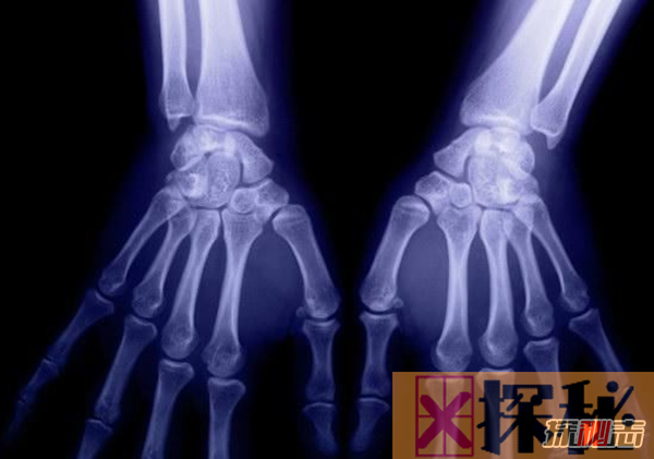 x射线在人体积累多久?长期接触x射线的十大危害