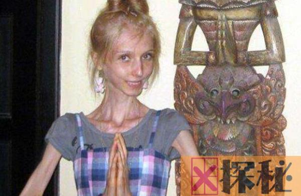 瘦成干尸的少女 俄罗斯少女因厌食症仅为20公斤