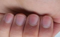 指甲上的月牙是什么?月牙少是不是身体不好