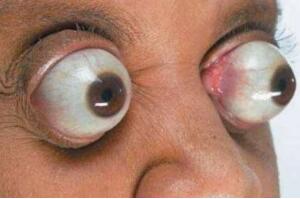 世界上眼球最突出的女人，金·古德曼（眼睛凸出11毫米）