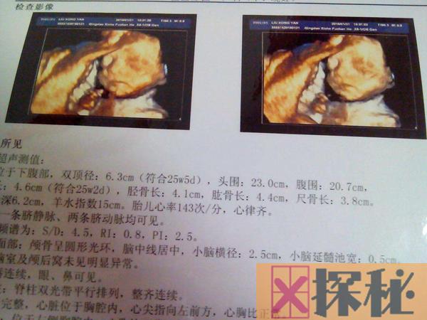 女子生出无眼婴儿 什么会导致胎儿没眼珠
