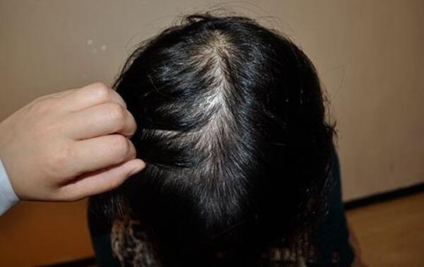 掉发的原因有哪些，经常熬夜、过度运动（头发护理不当）