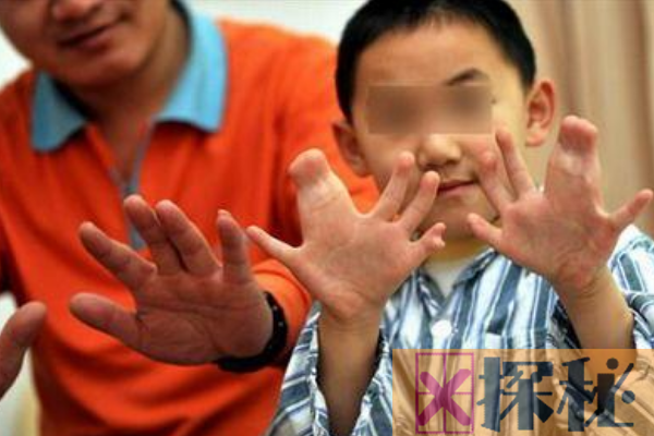 世界上手指脚趾最多的人:印度男孩多指畸形(34根手脚指)