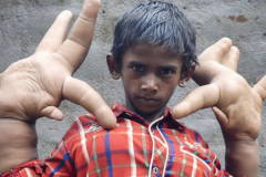 世界罕见巨指症男孩:双手重达12.7公斤(被称诅咒之人)