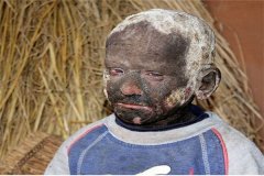 世界上皮肤最硬的人是谁 印度的小男孩尼尔（患病导致）