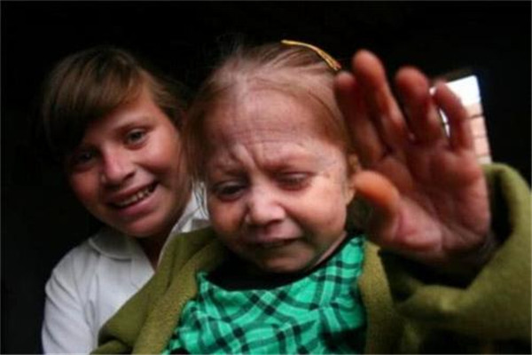 世界上最罕见的病症 儿童早衰症的患者外貌提前衰老