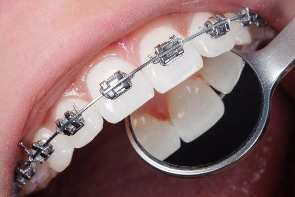 矫正牙齿会导致牙齿松动过早脱落吗 不会导致牙齿松动脱落