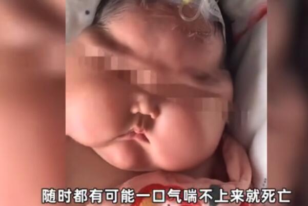5个月大的女婴抹了婴儿霜后变“大头娃娃”，月胖3斤