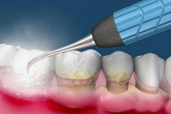洗牙的好处和坏处:易导致牙缝大(但能预防牙周疾病)
