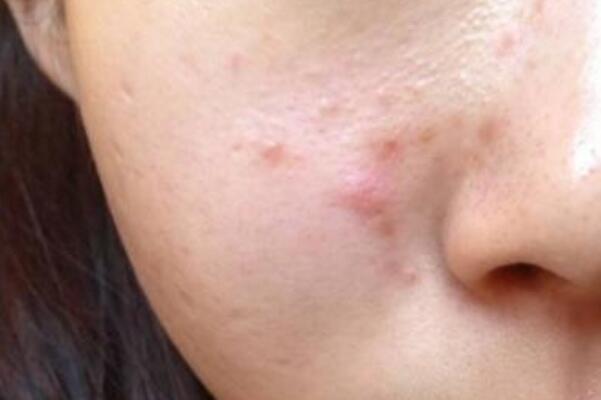 脸上长痘痘的位置和原因：鼻头长痘(胃火大且消化异常)