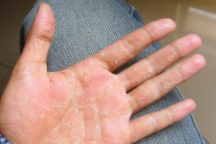 手脱皮是什么原因导致的：天气干燥导致脱皮(或皮肤病导致)