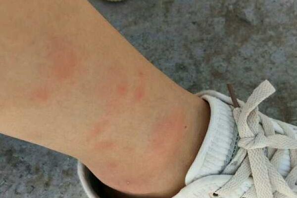 为什么有些人招蚊子咬：体温高、出汗多(与血型无关)