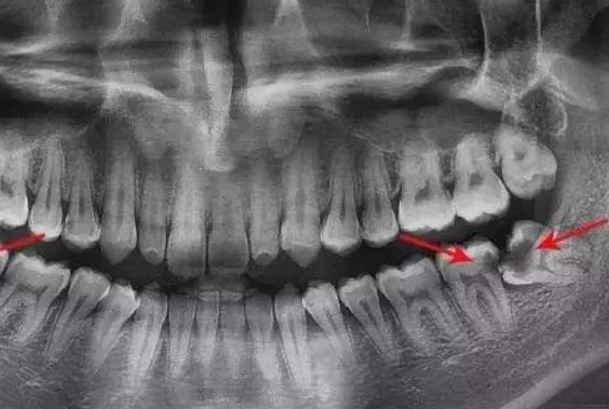 智齿从哪里长出来的：牙弓最靠里的位置(成年后生长)